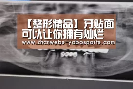 【整形精品】牙贴面可以让你拥有灿烂笑容“亚博”(图2) 亚博